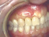 Abschließend: Einsetzen der Implantatkrone Eingesetzte Implantatkrone