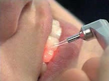 Laserbehandlung - Zahnarzt Braunschweig Laserbehandlung von Parodontitis